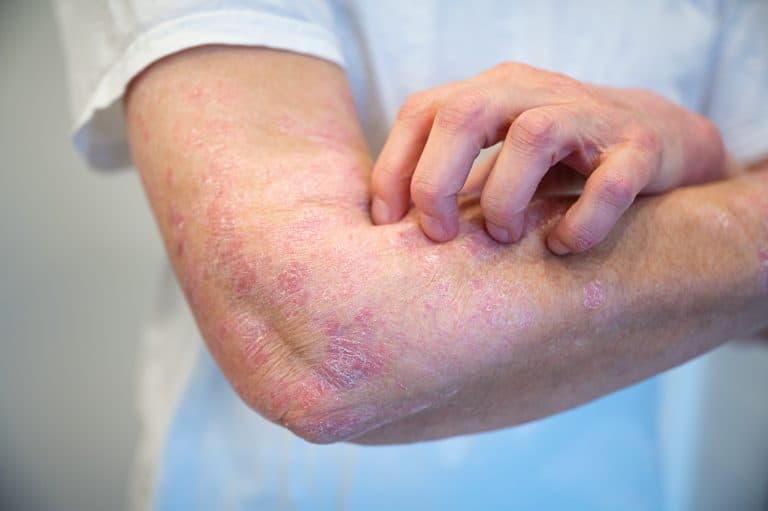 Pessoa coçando o braço com placas avermelhadas e descamação na pele, características comuns da psoríase, doença inflamatória que não é contagiosa.